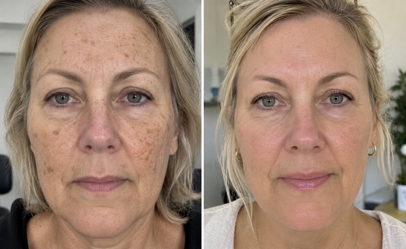Pigmentation photographs